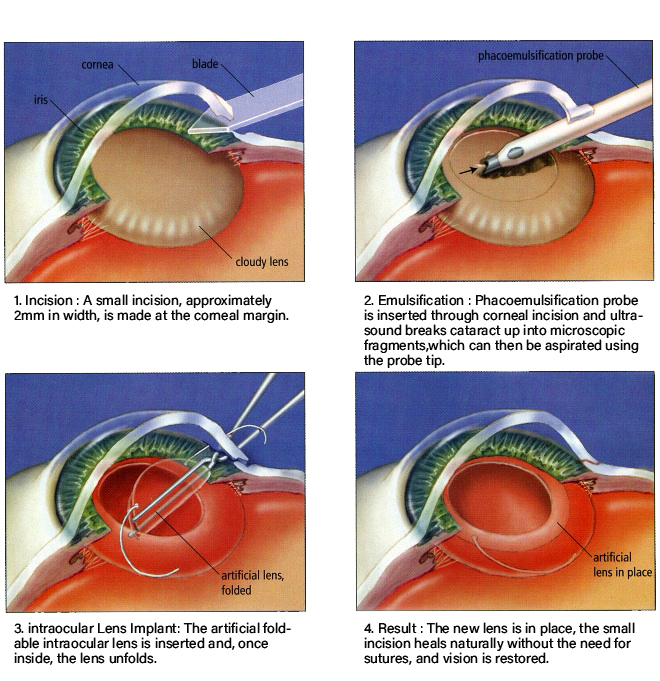 case study of cataract patient