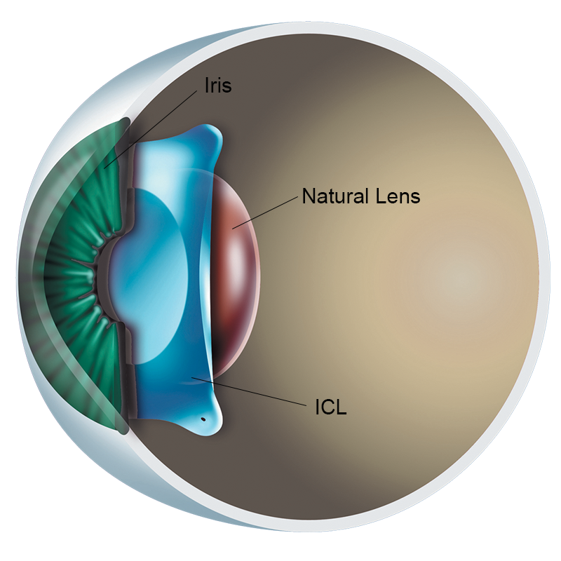Implantable Collamer Lens (ICL) Surgery